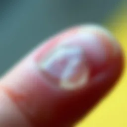 Close-up of a blister on a finger illustrating the common occurrence.